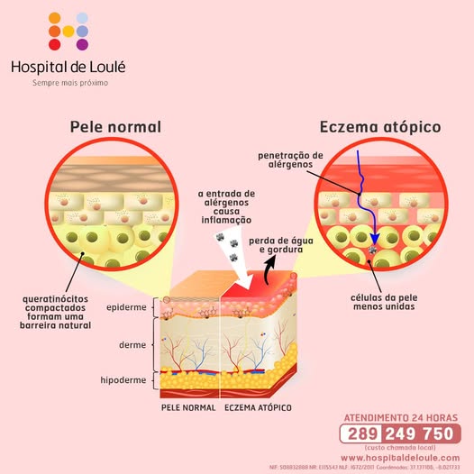 Eczema atópico